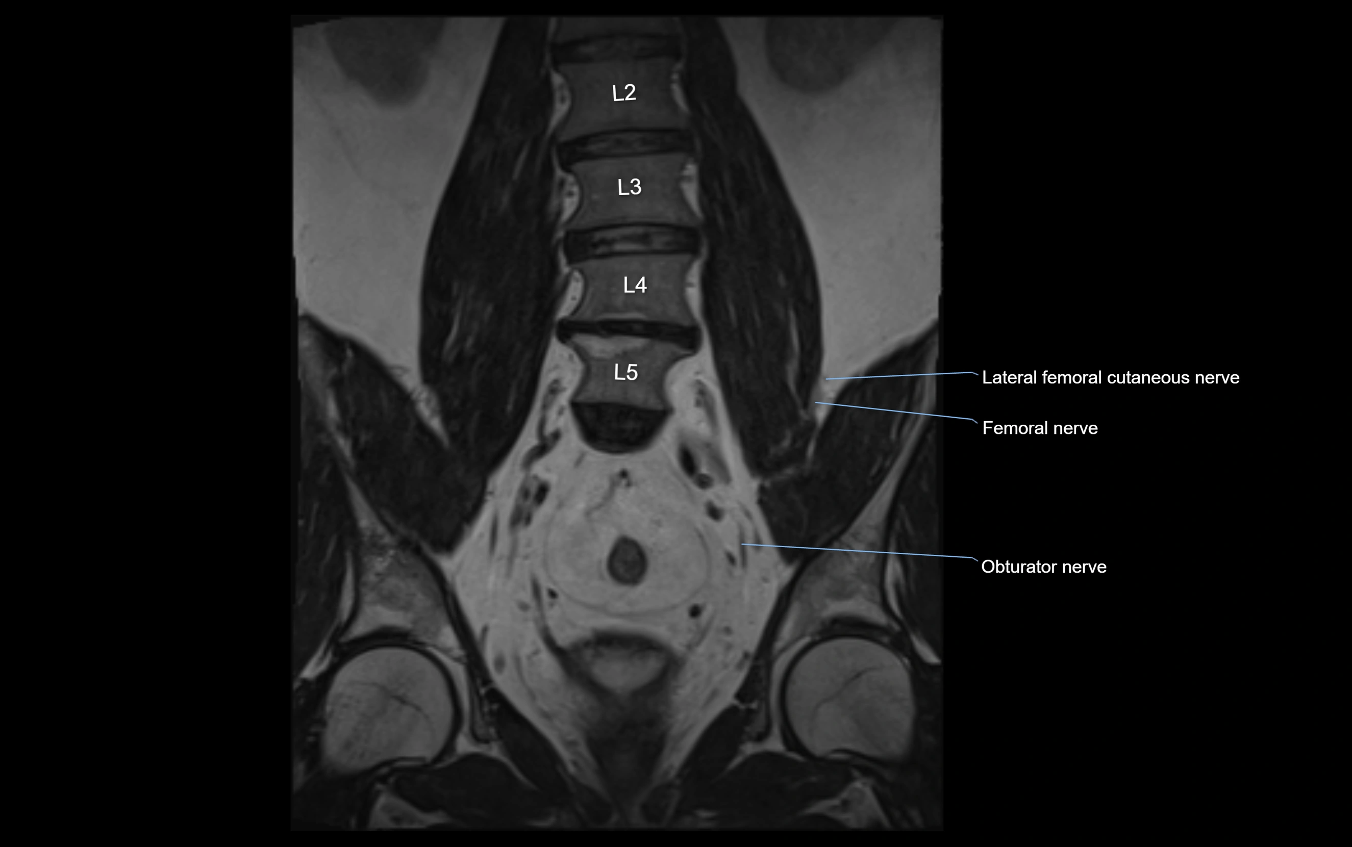MR lumbosacral plexus cross sectional anatomy 3T  radiology  image-img-09001-00022.webp
